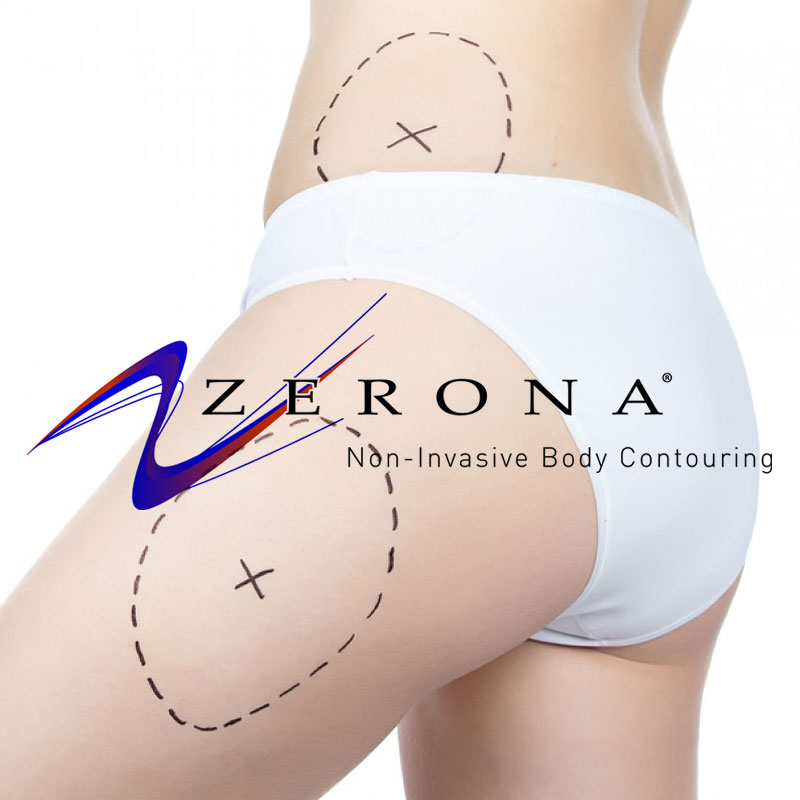 zerona laser fat removal